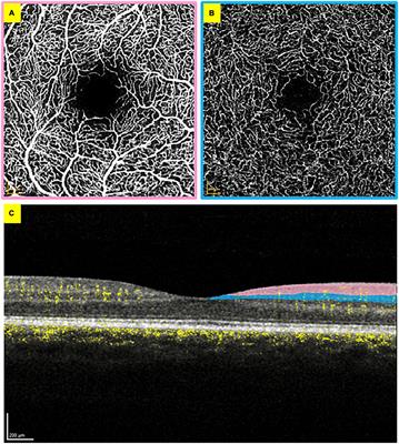 Optical coherence tomography angiography as a surrogate marker for end-organ resuscitation in sepsis: A review